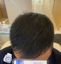 -大麦微针植发丨全国连锁