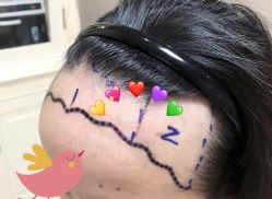 -大麦微针植发全国连锁