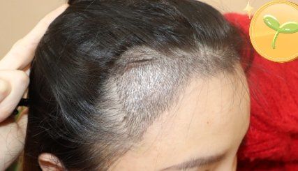 -大麦微针植发丨全国连锁