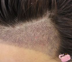 -大麦微针植发丨全国连锁