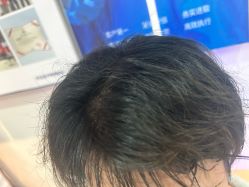 点击看大图 -碧莲盛·不剃发植发