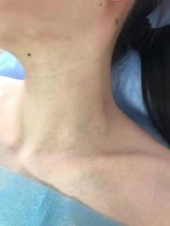 -美丽人生祛斑扁平疣汗管瘤中心