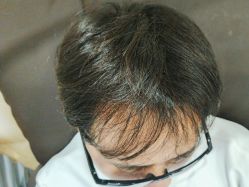 -碧莲盛·不剃发植发