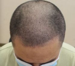 -大麦微针植发丨全国连锁