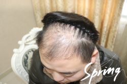 -大麦微针植发全国连锁