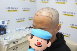 -大麦微针植发丨全国连锁