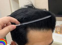 -大麦微针植发丨全国连锁