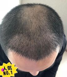 -大麦微针植发丨全国连锁