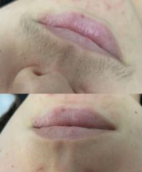 -薇兰专业脱毛连锁机构