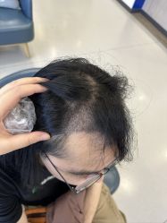 体验后-大麦微针植发全国连锁