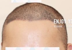 -大麦微针植发全国连锁