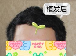 -大麦微针植发全国连锁
