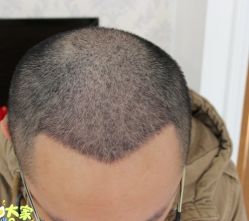 -大麦微针植发丨全国连锁