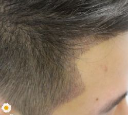 -大麦微针植发丨全国连锁