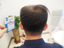 -大麦微针植发丨全国连锁