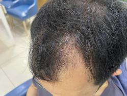 -大麦微针植发全国连锁