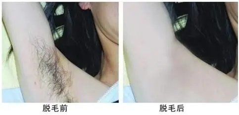 -HEYAN荷妍专业脱毛连锁机构