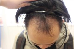 点击看大图 -大麦微针植发丨全国连锁