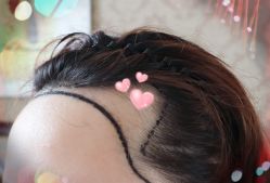 -大麦微针植发全国连锁