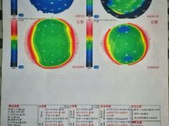 全飞秒术前眼科检查-上海大学附属上海和平眼科医院