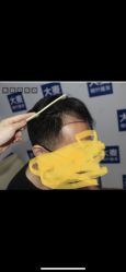 点击看大图 -大麦微针植发丨全国连锁