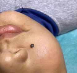 -清疣美疣·痣·斑净肤中心