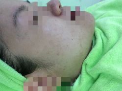 -苗医生草本科技祛痘