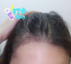 -大麦微针植发全国连锁