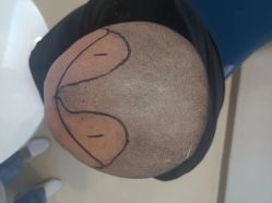 点击看大图 -大麦微针植发丨全国连锁