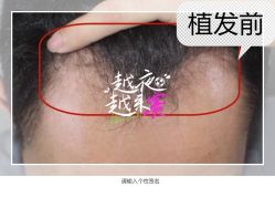 -大麦微针植发全国连锁