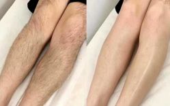 -薇兰专业脱毛连锁机构