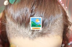 -大麦微针植发全国连锁