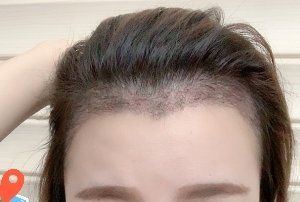 -大麦微针植发丨全国连锁