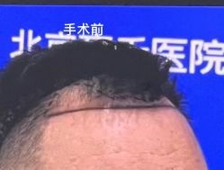 -北京雍禾植发医院