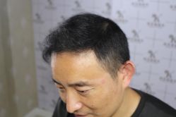 -大麦微针植发丨全国连锁