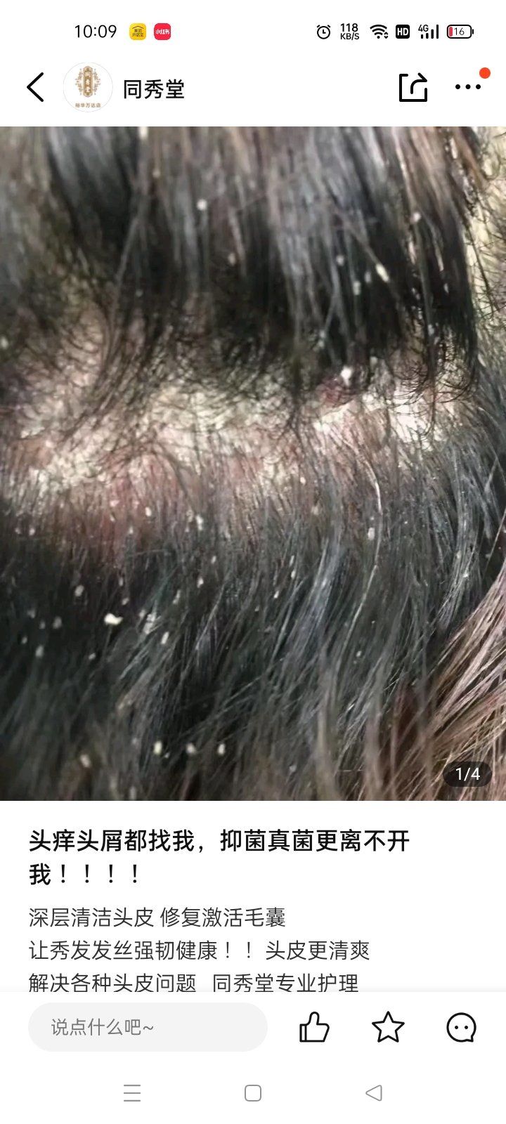 头皮屑真是烦人!