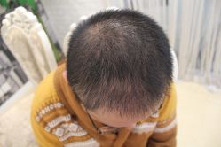 点击看大图 -大麦微针植发丨全国连锁