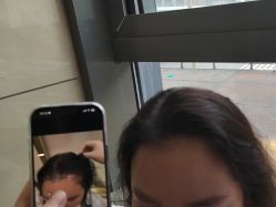 -碧莲盛·不剃发植发