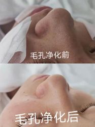 -凡碧诗毛孔清洁收细