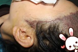 -大麦微针植发丨全国连锁