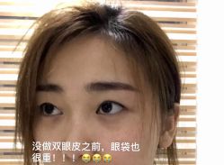 体验前-东莞缔美美容医院