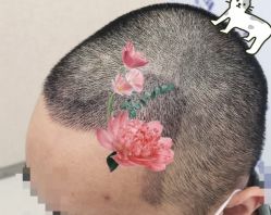 -大麦微针植发全国连锁