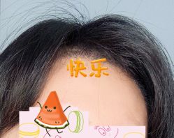 -大麦微针植发全国连锁