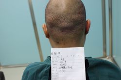 点击看大图 -大麦微针植发丨全国连锁