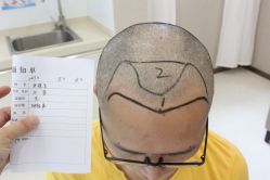 点击看大图 -大麦微针植发丨全国连锁