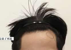 -大麦微针植发全国连锁