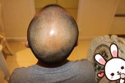 点击看大图 -大麦微针植发丨全国连锁