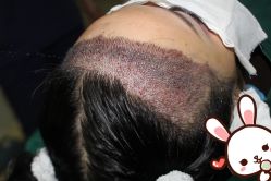 -大麦微针植发丨全国连锁