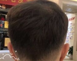 -大麦微针植发全国连锁
