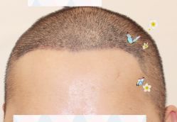 -大麦微针植发全国连锁